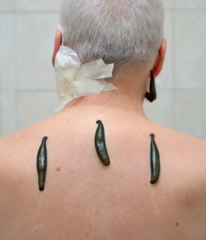 Sülük yapışmış adam